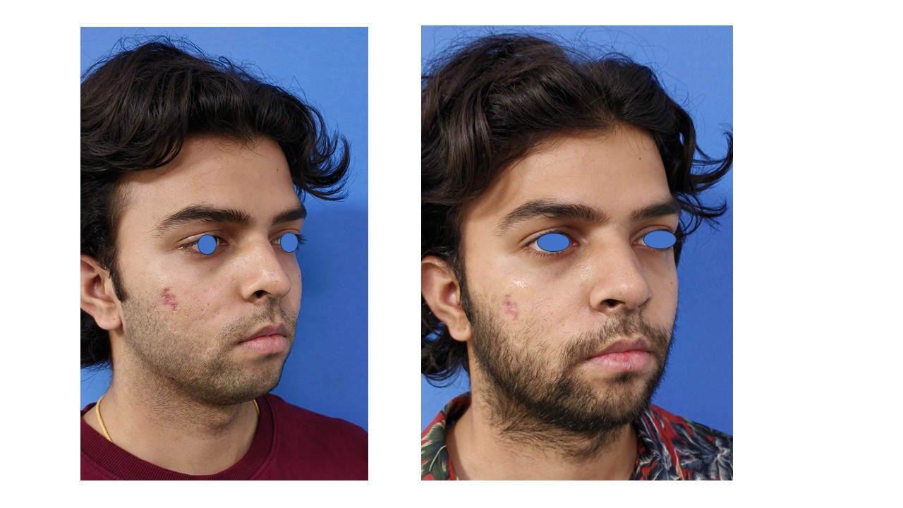 Rhinoplasty Photo 11